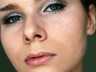 How to treat adult acne? My ways of dealing with it